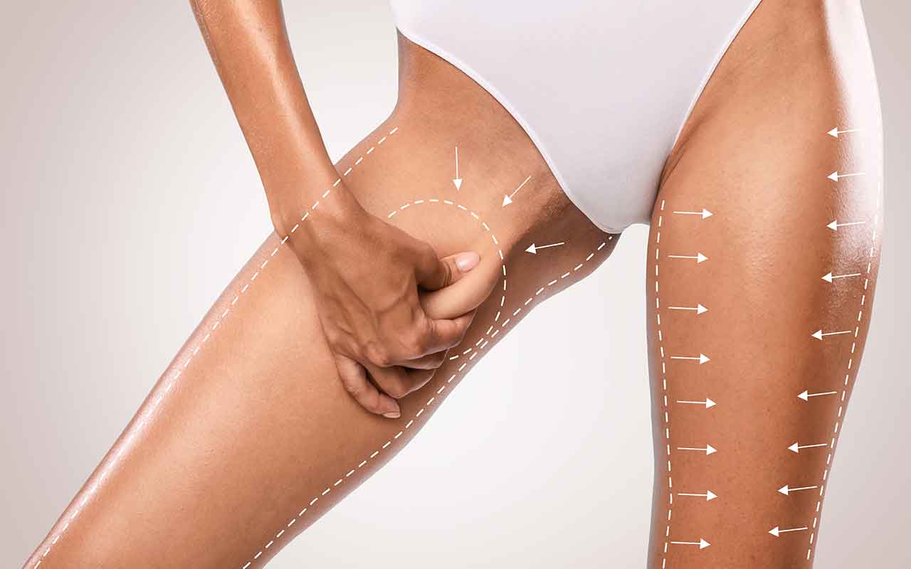 Comment raffermir les cuisses après une sleeve