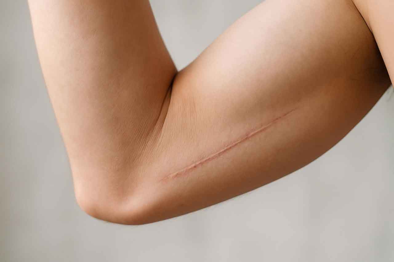 cicatrice du lifting des bras disparaît-elle totalement au bout d’un an