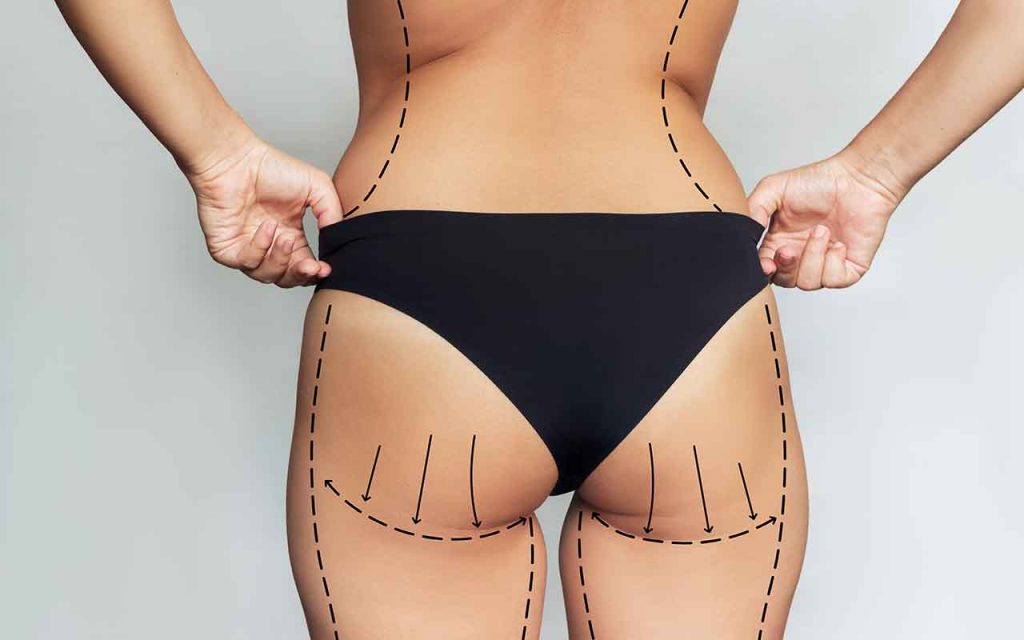 implant-fessier-en-Tunisie