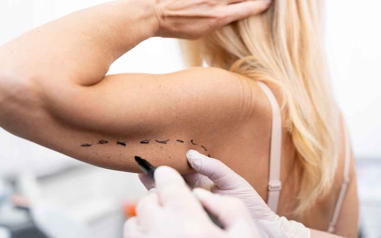 la cicatrice du lifting des bras : types et localisation selon la brachioplastie