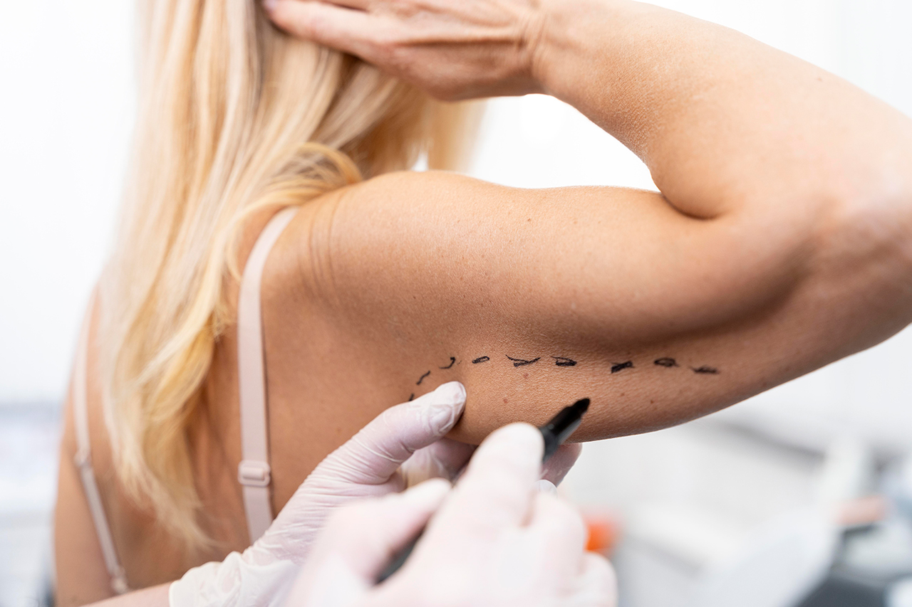 lifting-Chirurgie-du-bras-en-Tunisie