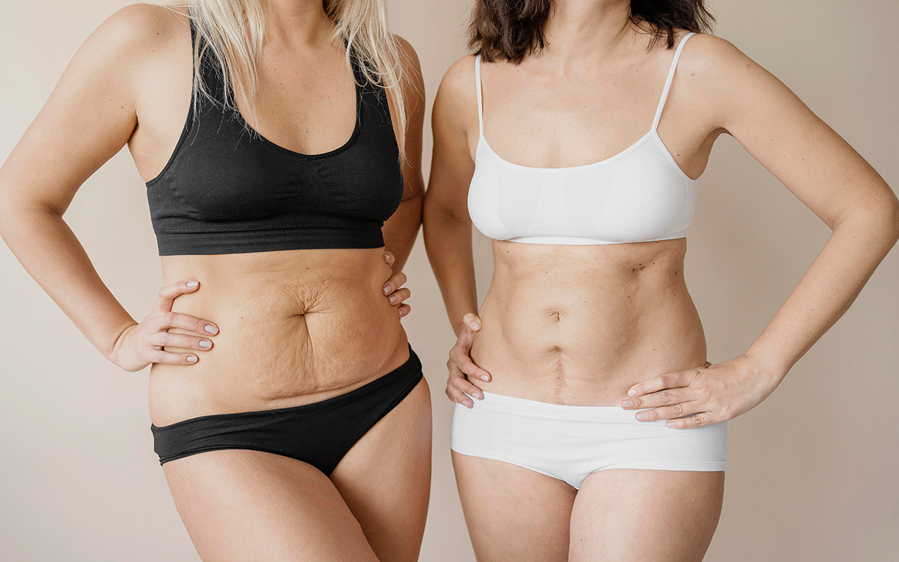 prix d’une abdominoplastie en Tunisie avec hébergement