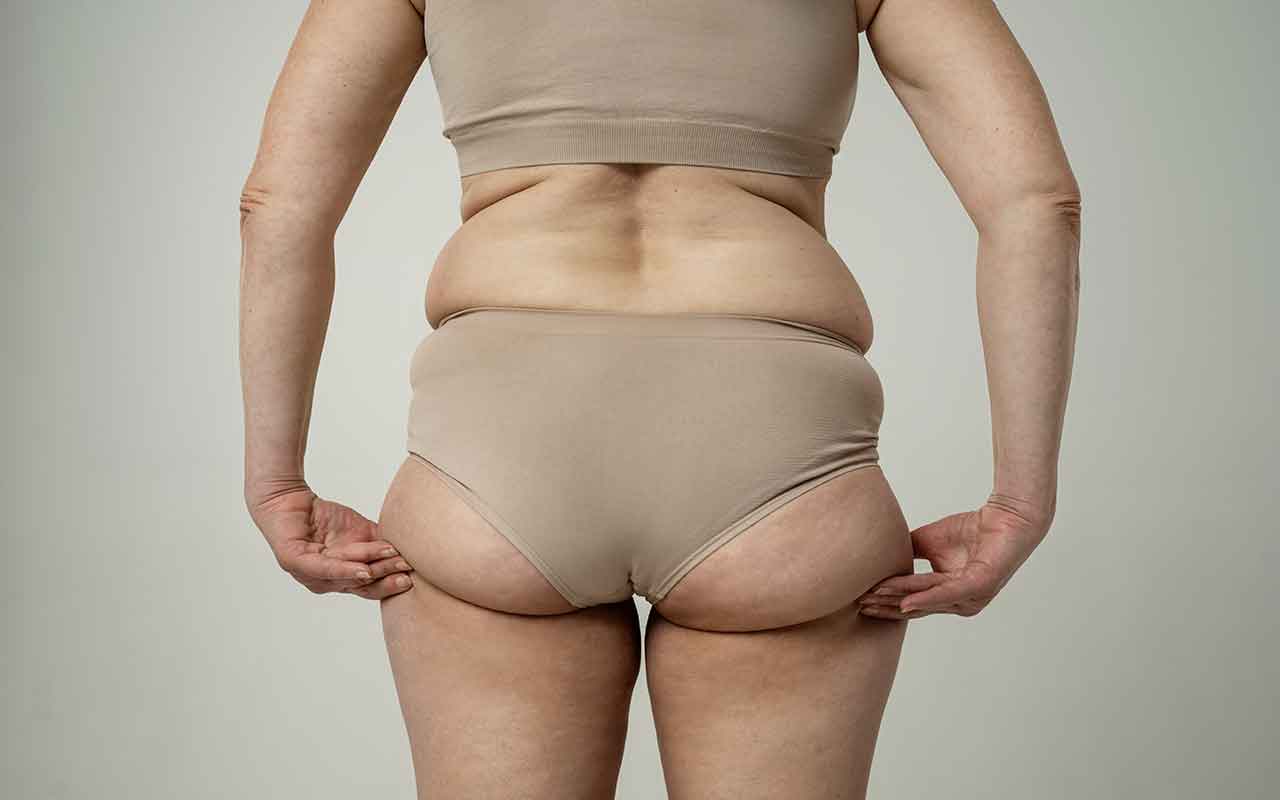 Chirurgie des fesses : quelles solutions pour corriger une asymétrie fessière