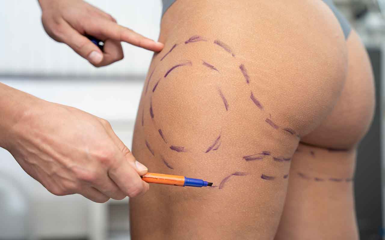 Implants fessiers : quelles douleurs après l’opération