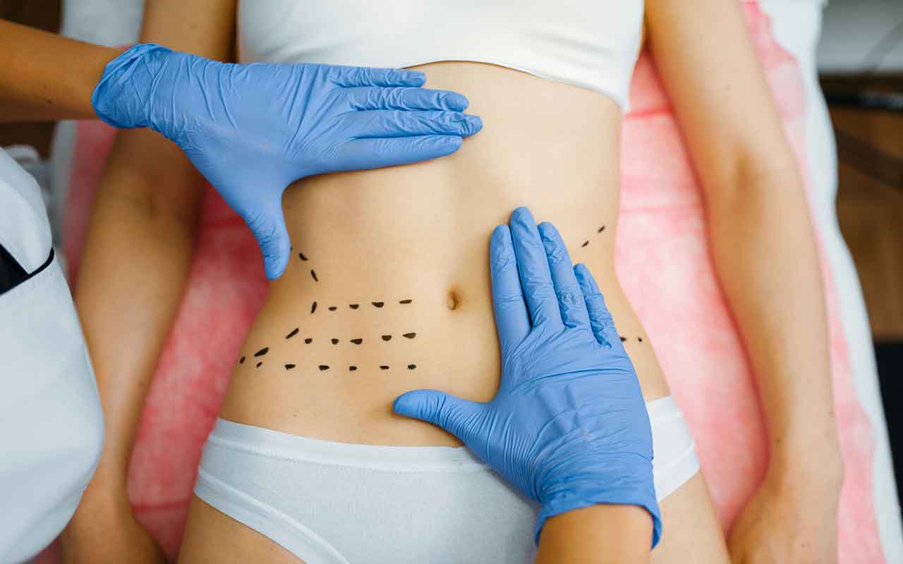 Mini-abdominoplastie